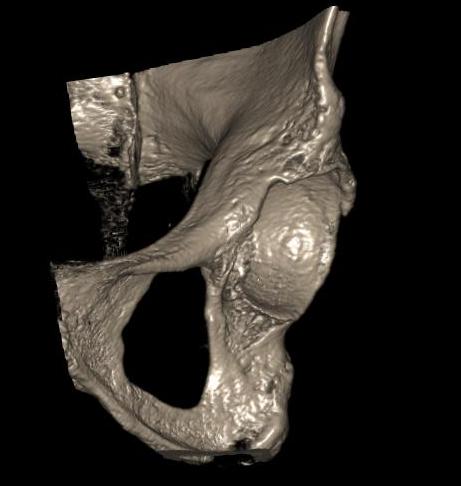 Pelvis Anterior Column